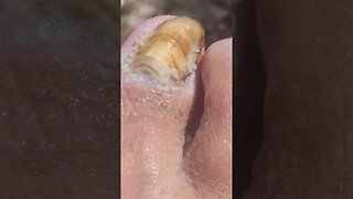 Can Appleceder vinegar take out nail fungus?yes