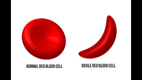I Am Looking For 10 Open Minded Sickle Cell People! 317-709-8045