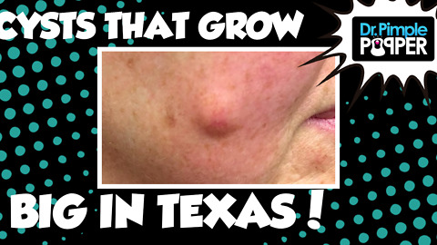 They Grow Cysts BIG in Texas...