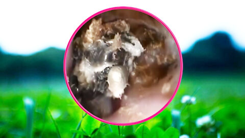 Ear Wax Removal With Clam Relaxing Music #13