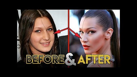 Bella Hadid | Before and After Transformations ( Plastic Surgery Rumors, Make Up, Fitness & More )