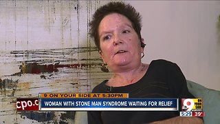 Woman with 'stone man syndrome' still waiting for relief