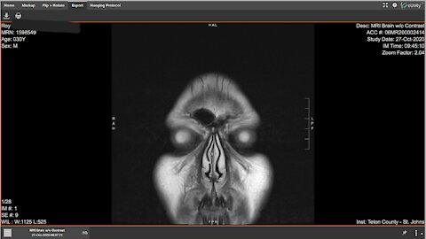 Nov.6th 2021- LiveStream on MRI showing graphene nano on Brain. After 2020 covid swab injury.