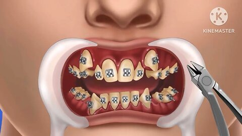 Dental implants, dental implants australia, all on 4 dental implants, dental implants procedure
