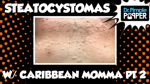 Caribbean Momma & Her Steatocystomas! Session One, Part Two