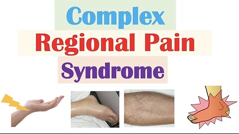 Complex Regional Pain Syndrome | Causes, Pathophysiology, Signs & Symptoms, Diagnosis, Treatment