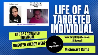 Microwave Burn Directed Energy Weapon Healing Journey day 6