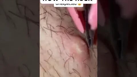 Newest pimple removal 2022 Cystic acne extractions whiteheads new