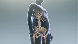 Total hip replacement part 3 hip - human animated anatomy