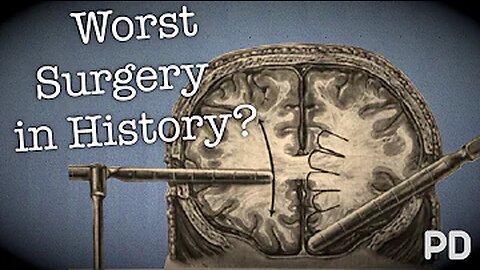 The Dark side of Science: The Lobotomy, the worst surgery in history? (Documentary)