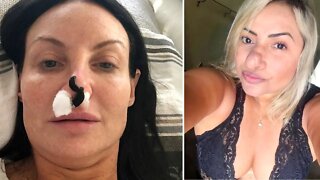 When Nose Jobs Go Wrong