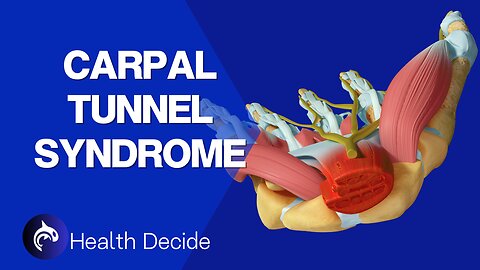 Carpal Tunnel Syndrome and Treatment - 3D Animation