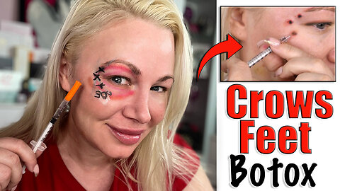 How I do Crows Feet Botox | Botox Tips and Tricks | Code Jessica10 Saves you Money!