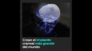 En Chile crean el implante craneal más grande del mundo