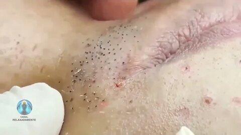 Blackheads Removal - Best Compiled 2022