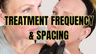 Treatment Spacing // How often // Facial Rejuvenation