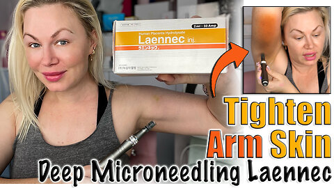 Deep Microneedling Laennec (placenta) to Tighten Loose arm skin, AceCosm | Code Jessica10 saves $$