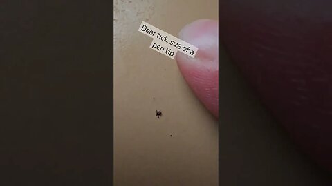 deer tick that was attached to my arm #tick #parasite #fyp #shorts #short #shortvideo #viral #foryou