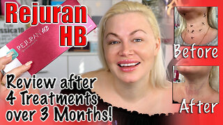 Rejuran HB - 4 Treatment Results from AceCosm | Code Jessica10 saves you Money at Approved Vendors
