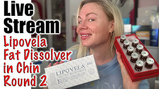 Lipovela in Chin and Nasalabial folds, This is PINCHY! Maypharm.net | Code Jessica10 saves you money