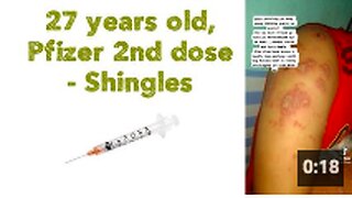 27 years old, Pfizer 2nd dose 💉 - Shingles
