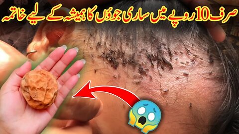 Sar Ki Juen Khatam Karne Ka Tarika | جوئیں ختم کرنے کا طریقہ | Head Lice Removal