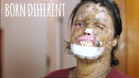 The Woman Who Is Allergic To Sunlight | BORN DIFFERENT