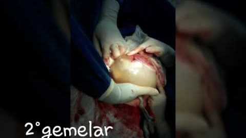 Child is born while still inside amniotic sac