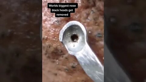 World biggest black heads get removed