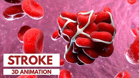 Understanding the Different Types of Stroke | 3D Animation