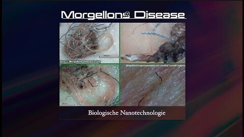 Morgellons Disease - Martijn van Staveren - Nederlands