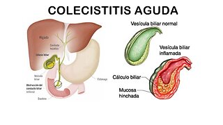 COLECISTITIS BIODESCODIFICACION