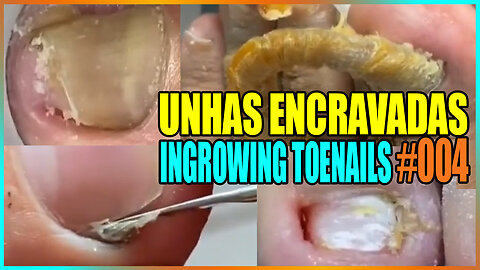 INGROW TOENAILS #004