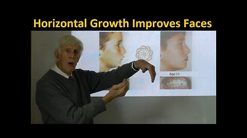 Horizontal & Forward Direction of the Jaws Growth Improves Faces by Prof John Mew