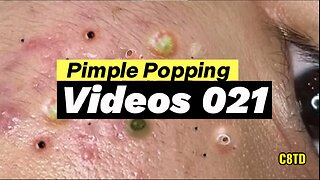 Satisfying Pimple Popping Videos 021