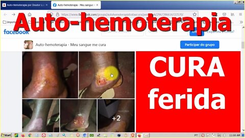 Auto-hemoterapia cura lesão infeccionada devido ao ferimento provocado por um gato.