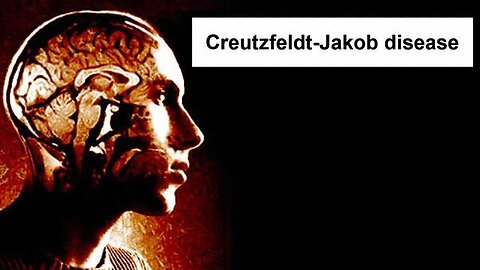 Will the rise of this disease kill off tens of millions this year? Creutzfeldt-Jakob (Prion Disease)