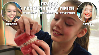 Braces Start to Finish Whitney Bjerken's Orthodontic Adventure