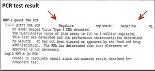 Human Herpesvirus 6 PCR Test - NEGATIVE Following Scalar Light Sessions