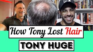 Tony Huge on His Hair Loss: Stress, not Androgens