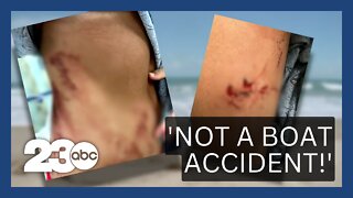 Teen girl survives shark attack