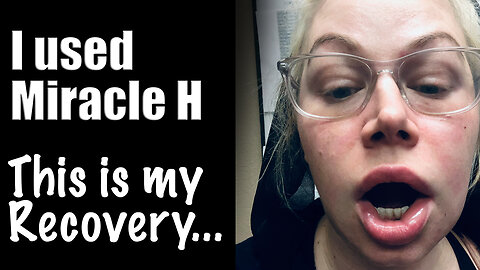 Miracle H Swelling, it happens and it will be OK! Here's my story | Wannabe Beauty Guru
