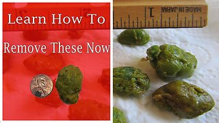 How to perform A Very Successful Liver/Gallbladder Flush