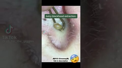 Juicy blackhead extraction 😨 #shorts #blackheadremoval #blackhead #blackheads #blackheadsremoval