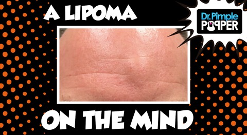 A Lipoma on his Mind...