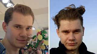 Minoxidil & Derma rolling Results 24 MONTHS | Month by Month Progress