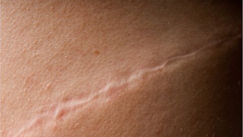 Hypertrophic scars explained: Why they occur and how to treat them