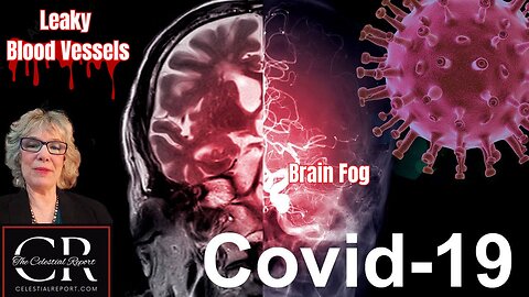 Connection Between Leaky Blood Vessels and Brain Fog in Long COVID Patients