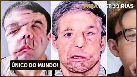 Lembra Do Homem De “Três Caras" Que Recebeu 2 Transplantes’ FAClAlS? Ele Ficou 21 Anos Mais Novo