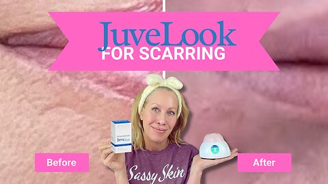 Juvelook PDLLA for Scarring and Acne